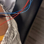 dry needling