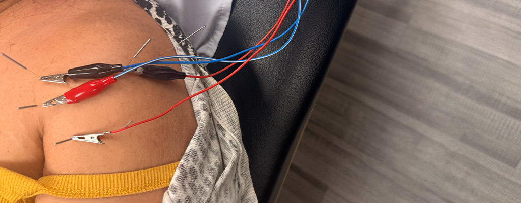 dry needling